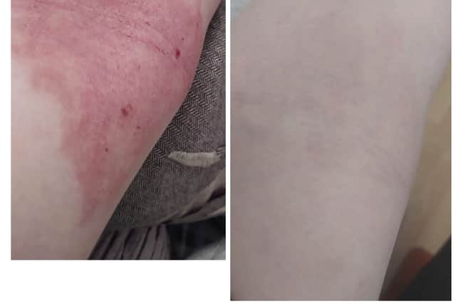 Our goats milk cream after just 10 days transformed this eczema flare up that steroids could not help