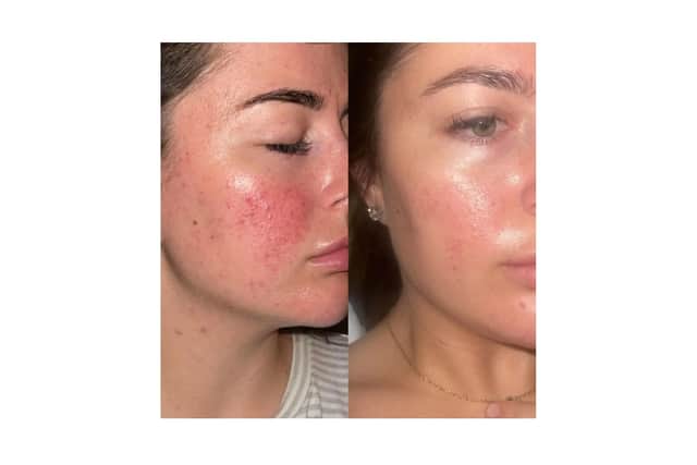 Jaime's results with 47 Skin
