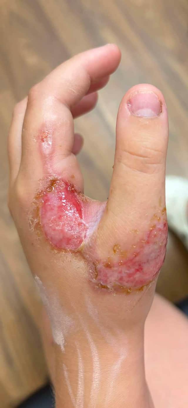 The injuries to Livi's hand