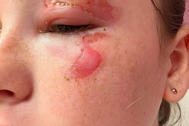 Squishy Toy Exploding Children burned by exploding ‘squishy’ toys amid trend to heat them in ...