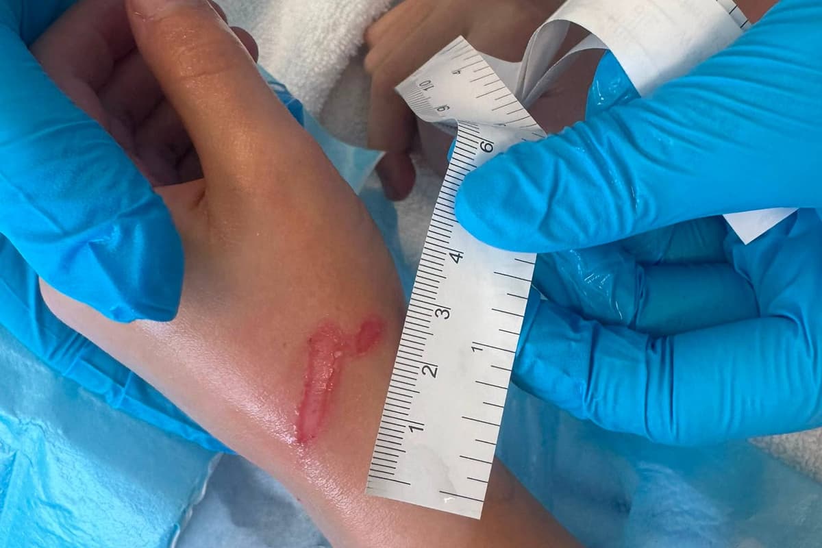 Squishy Toy Exploding Children burned by exploding ‘squishy’ toys amid trend to heat them in ...