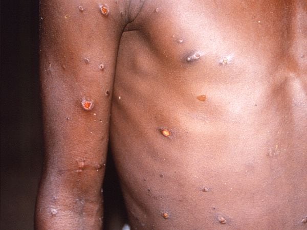 Monkeypox scars