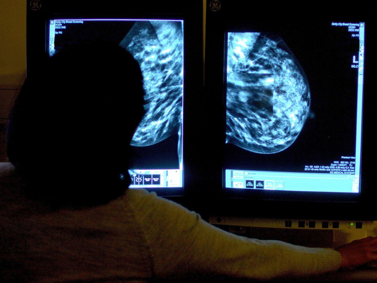 Scientists Find Targeting Tumour ‘scaffolding Slows Breast Cancer
