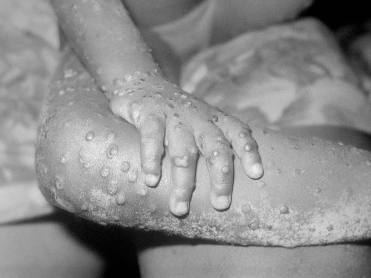 Number of monkeypox cases in UK rises to 57