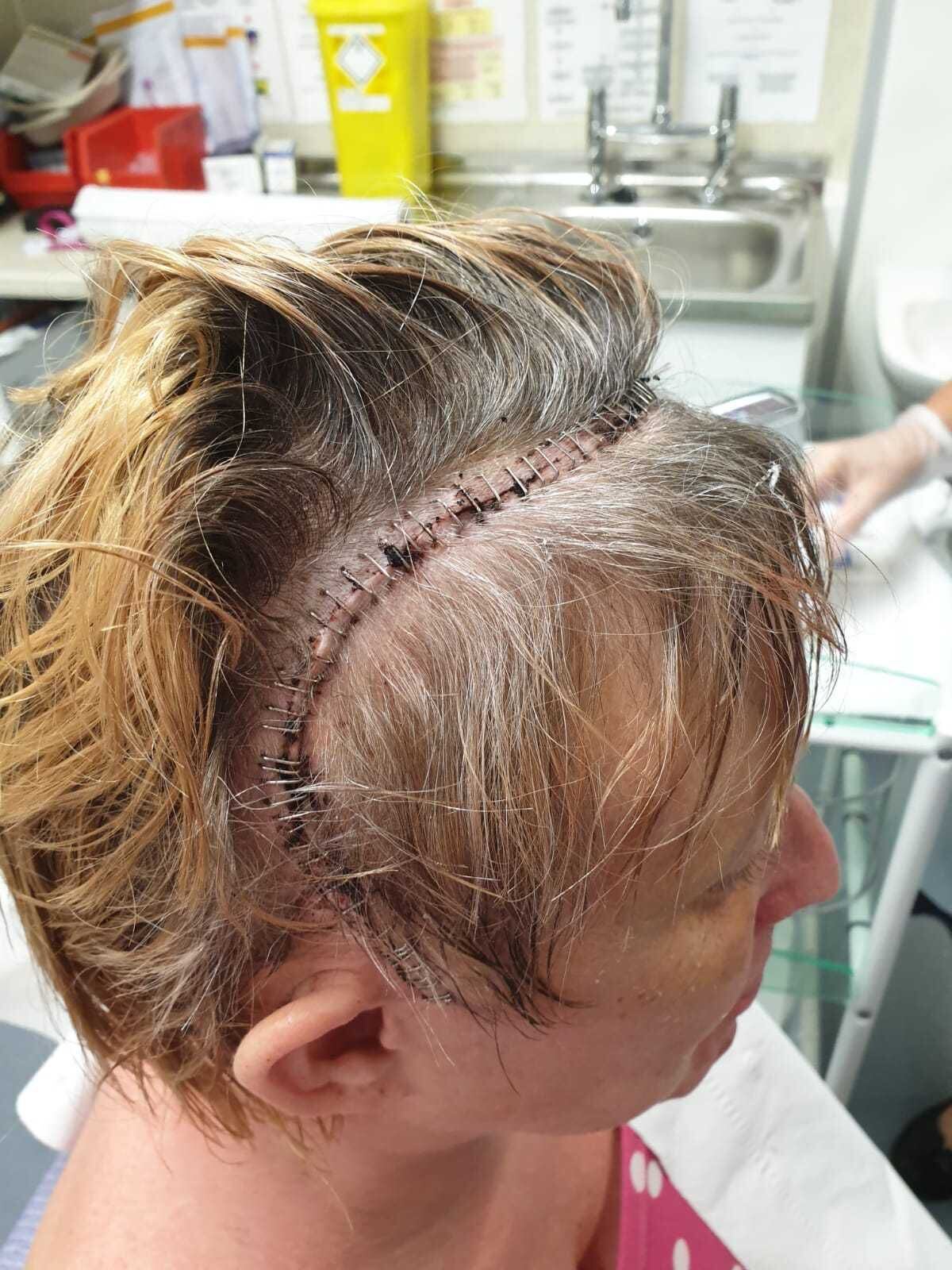Jo had 67 staples after her surgery