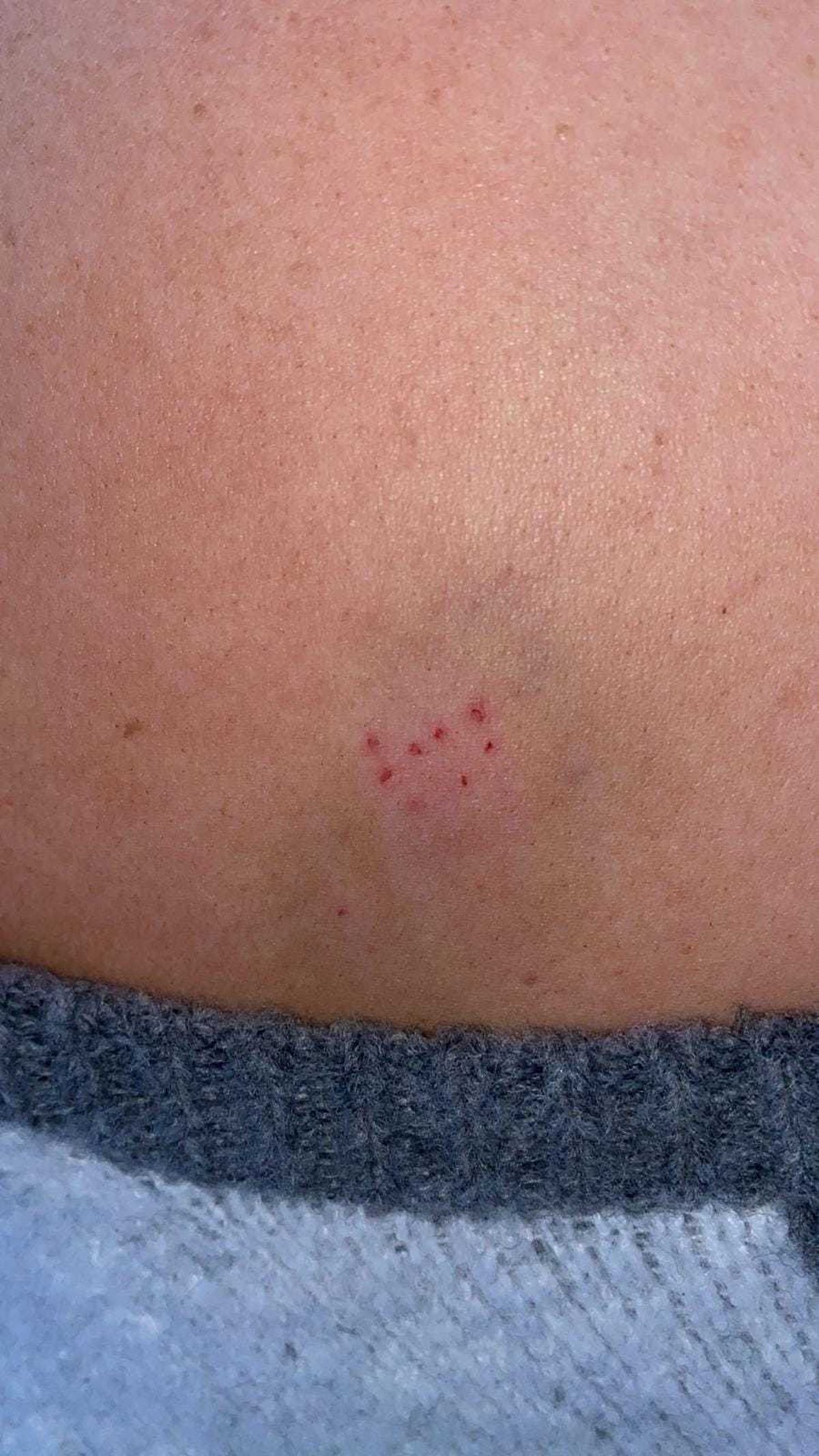 Laura Jones had a mark on her shoulder resembling a needle spiking wound