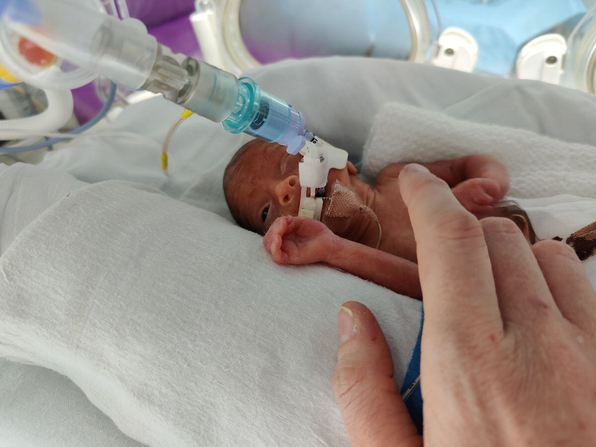 Molly-Mae Wainwright was born 14 weeks early, weighing just 1 pound and 15 ounces